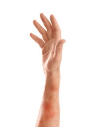 Image of Man showing hand with dry skin on white background, closeup