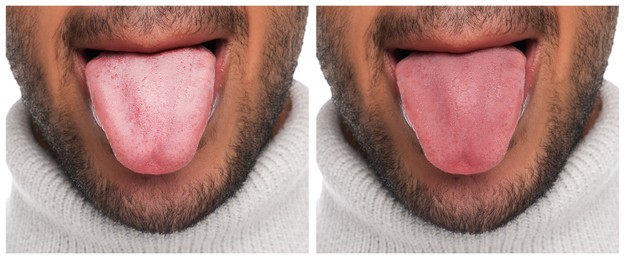 Collage with photos of man before and after tongue cleaning, closeup