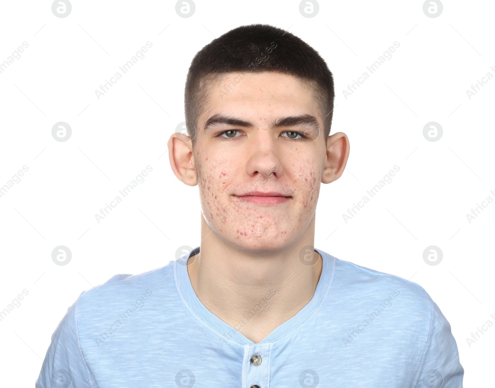 Photo of Young man with acne problem isolated on white