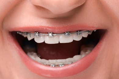 Photo of Happy woman with dental braces, closeup view