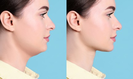 Image of Double chin problem. Collage with photos of young woman before and after plastic surgery procedure on turquoise background