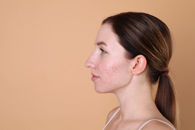 Young woman with acne problem on beige background. Space for text