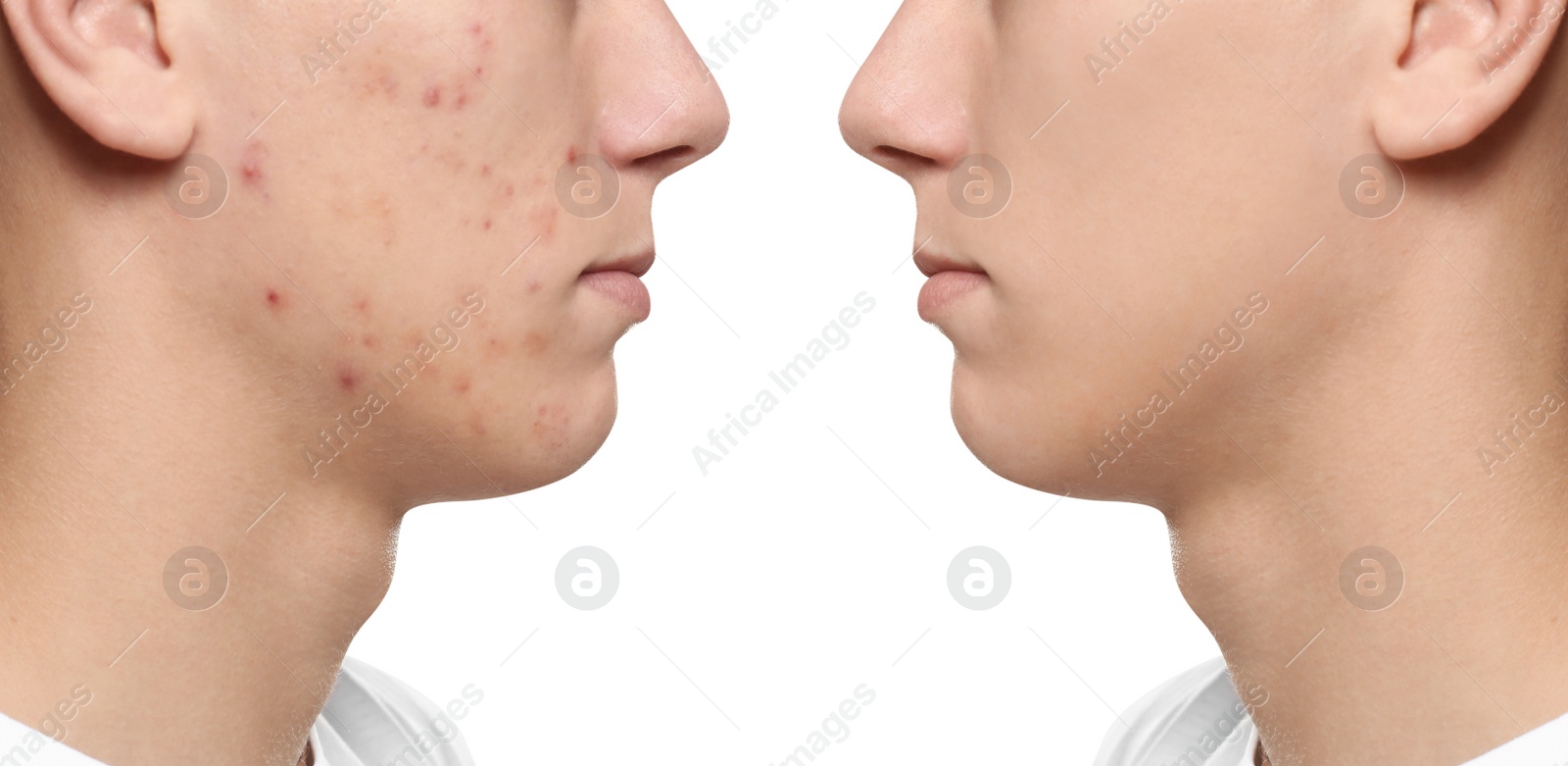 Image of Teenager before and after acne treatment on white background, closeup 