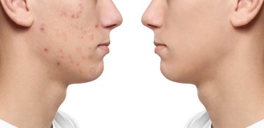 Image of Teenager before and after acne treatment on white background, closeup 
