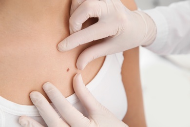 Dermatologist examining patient's birthmark in clinic, closeup