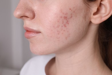 Photo of Woman with acne problem at home, closeup