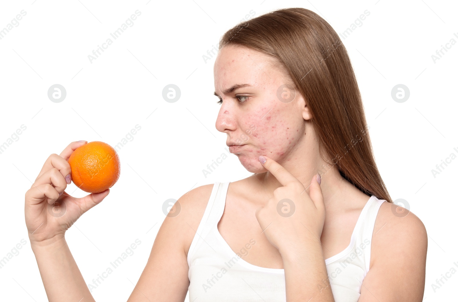 Photo of Young woman with acne problem holding orange on white background. Skin allergy