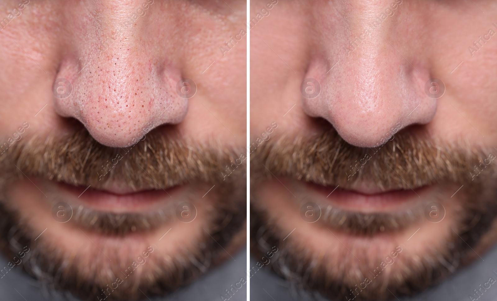 Image of Blackhead treatment, before and after. Collage with photos of man, closeup view