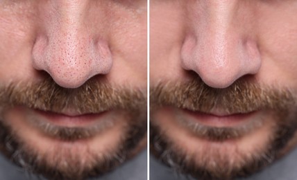 Image of Blackhead treatment, before and after. Collage with photos of man, closeup view