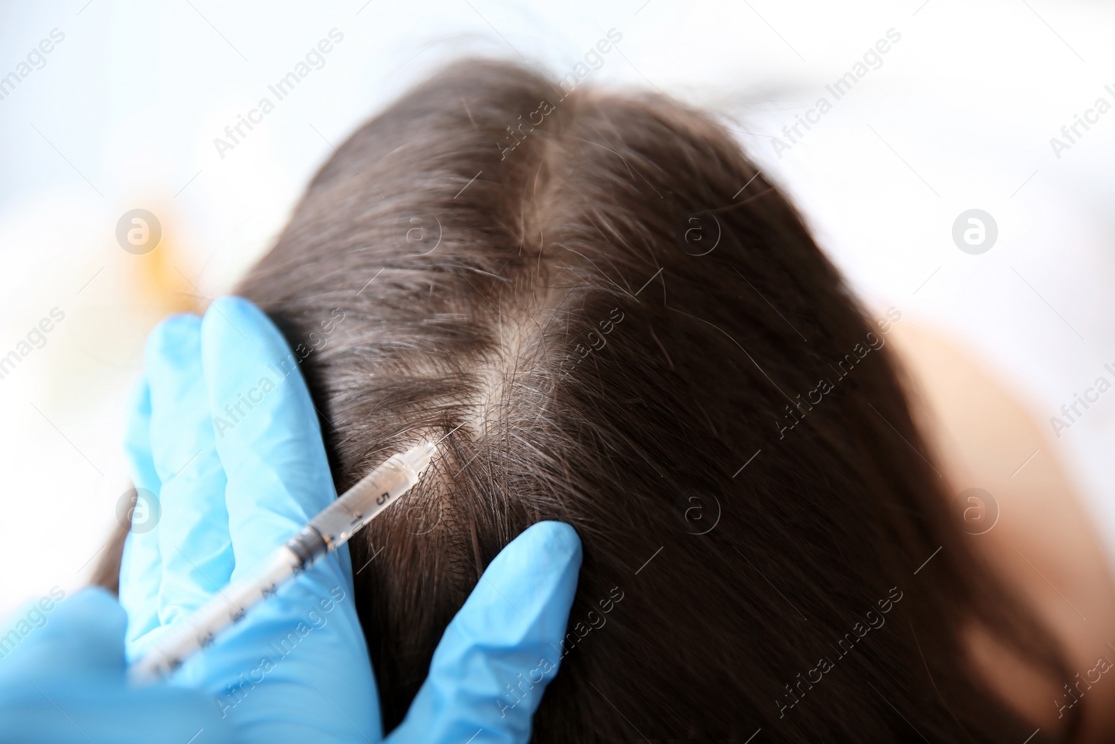 Photo of Young woman with hair loss problem receiving injection in clinic