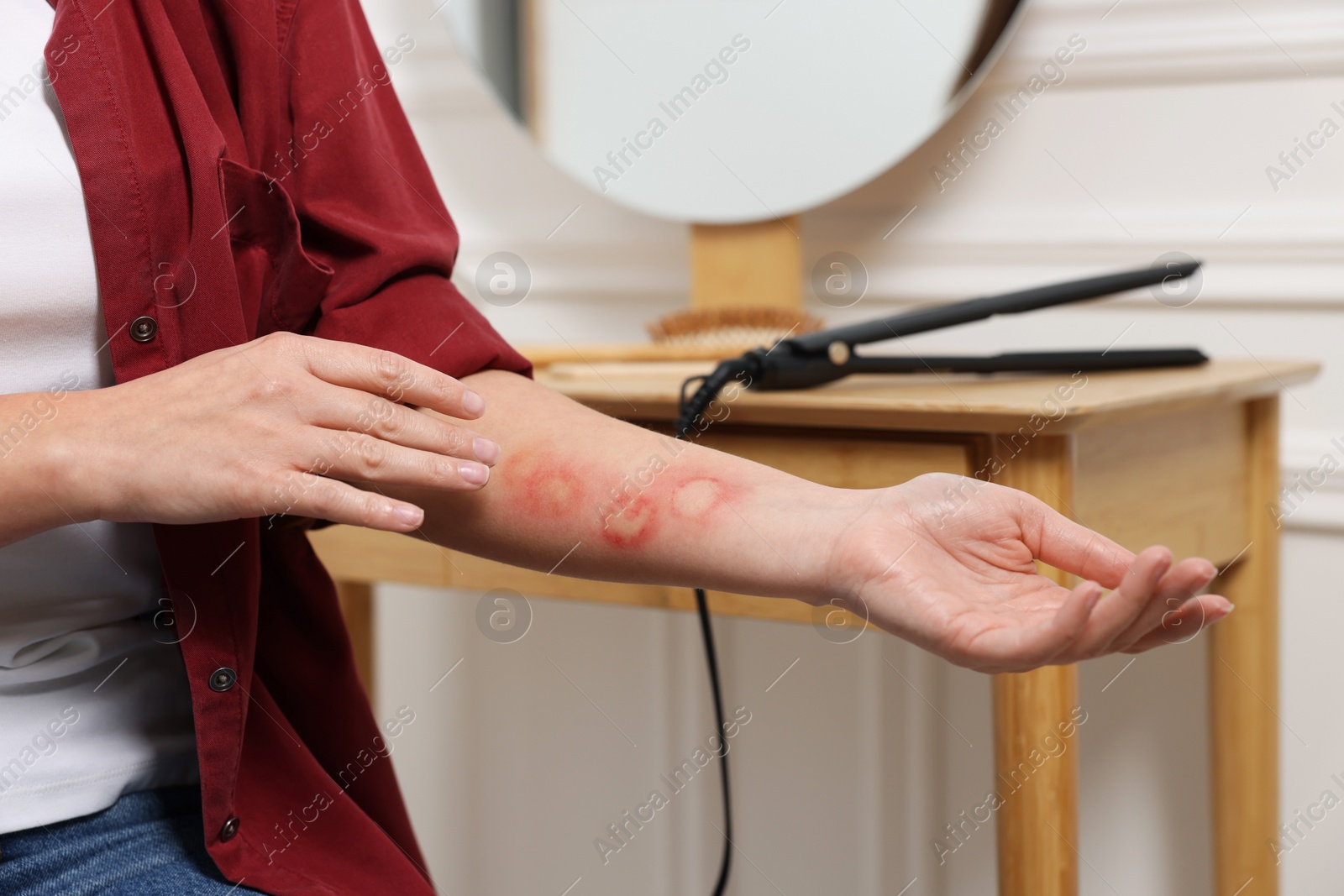 Photo of Woman with burns on her hand indoors, closeup