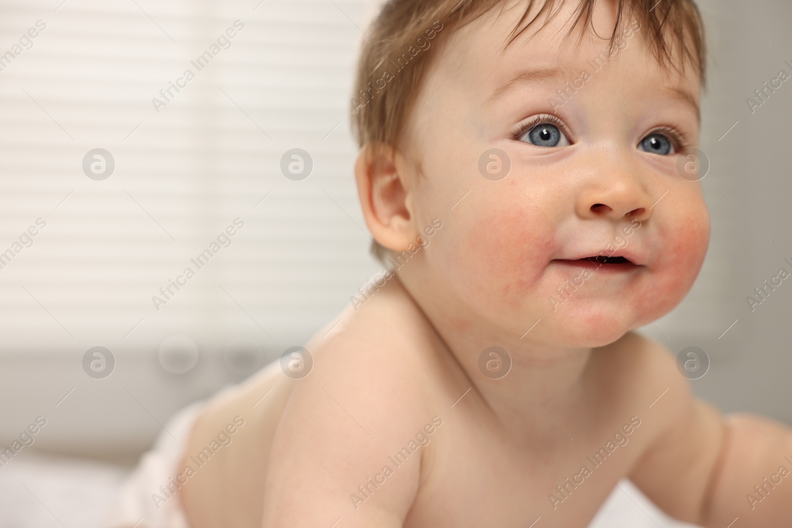 Photo of Cute little baby with allergic redness on cheeks indoors