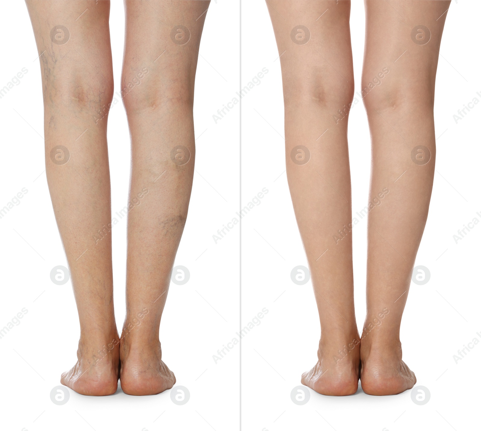 Image of Before and after varicose veins treatment. Collage with photos of woman showing legs on white background, closeup