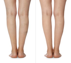 Before and after varicose veins treatment. Collage with photos of woman showing legs on white background, closeup