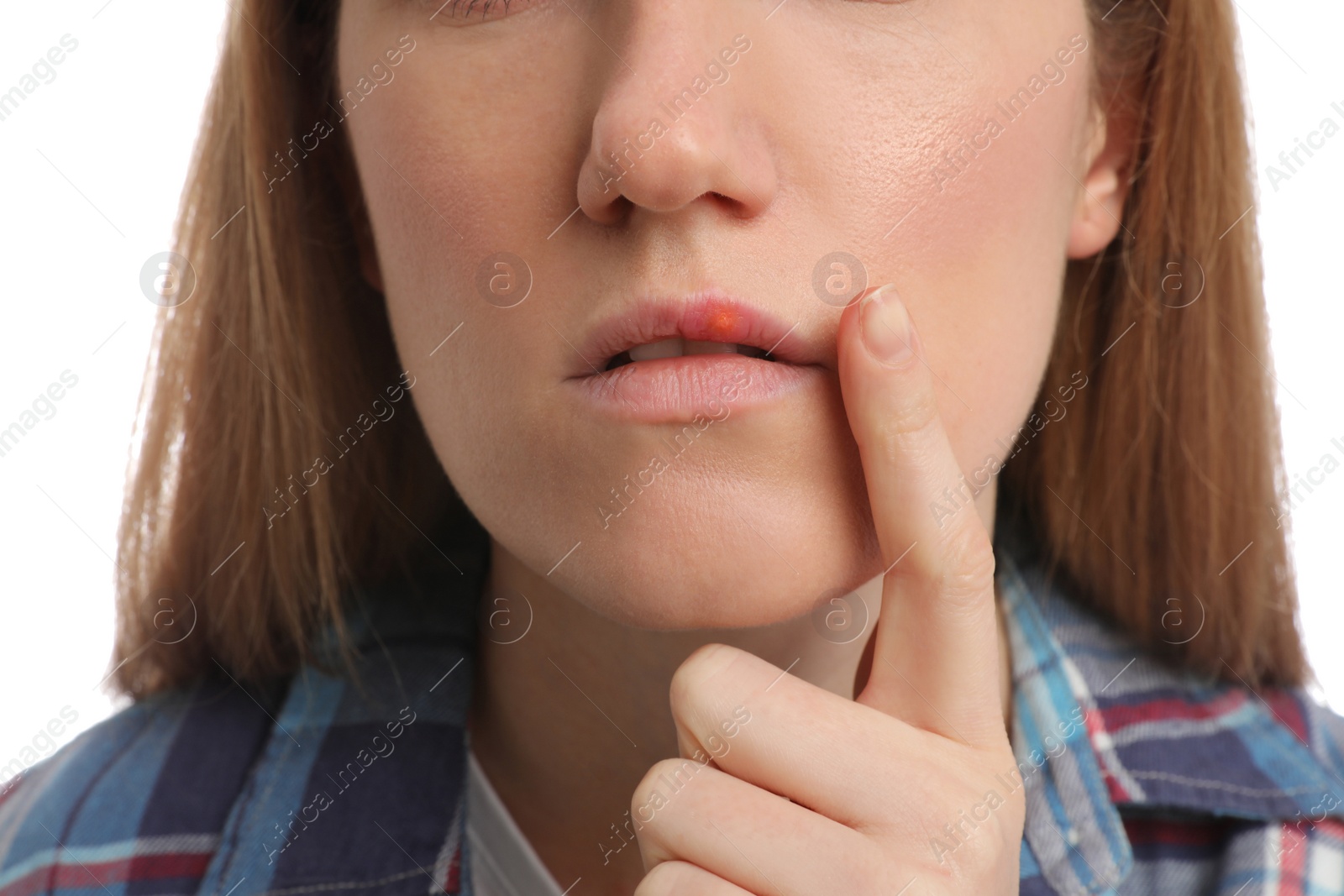 Photo of Woman suffering from herpes on white background, closeup