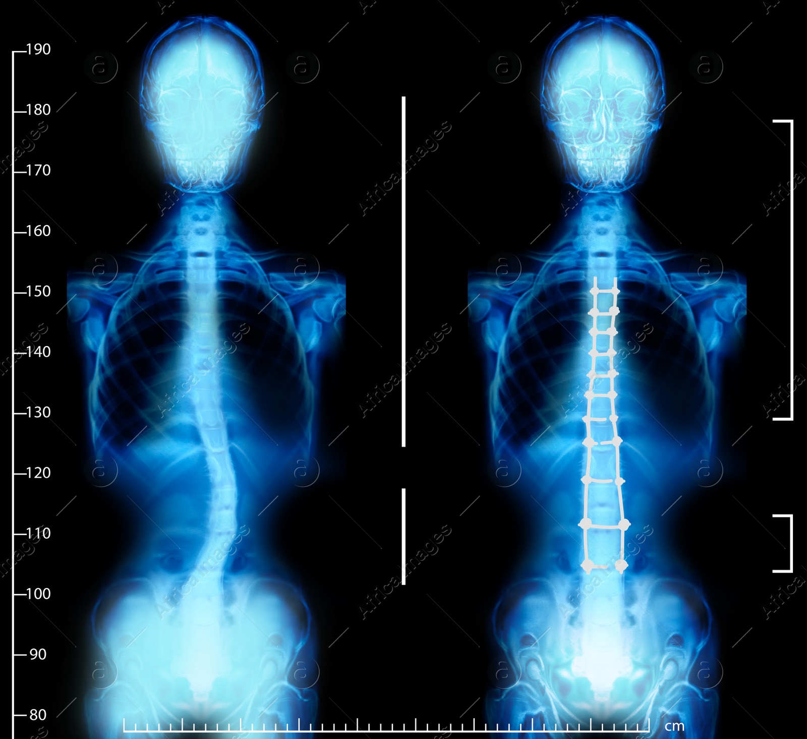 Illustration of X-rays of human normal and curved spines. Patient suffering from scoliosis