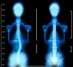Illustration of X-rays of human normal and curved spines. Patient suffering from scoliosis