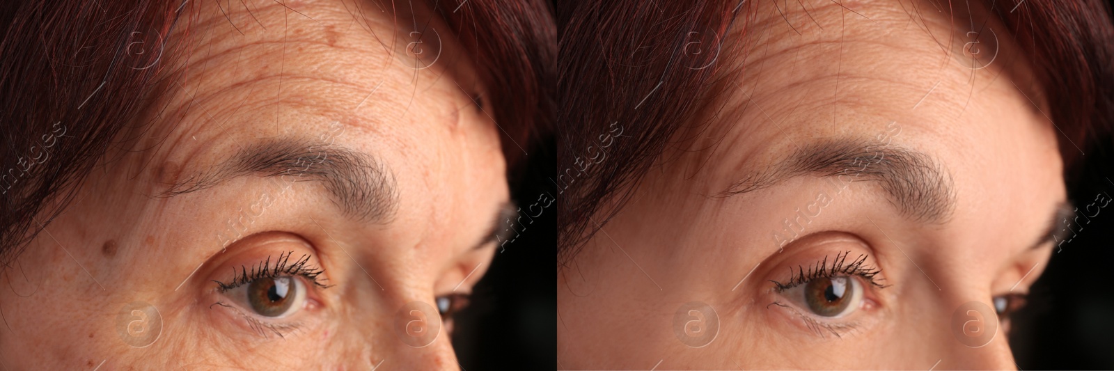 Image of Woman looking better due to cosmetic procedures. Collage with photos before and after rejuvenation, closeup