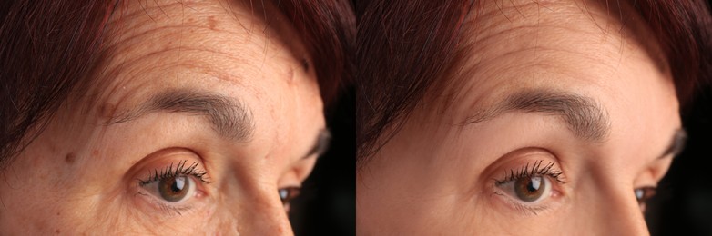 Image of Woman looking better due to cosmetic procedures. Collage with photos before and after rejuvenation, closeup