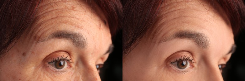 Woman looking better due to cosmetic procedures. Collage with photos before and after rejuvenation, closeup