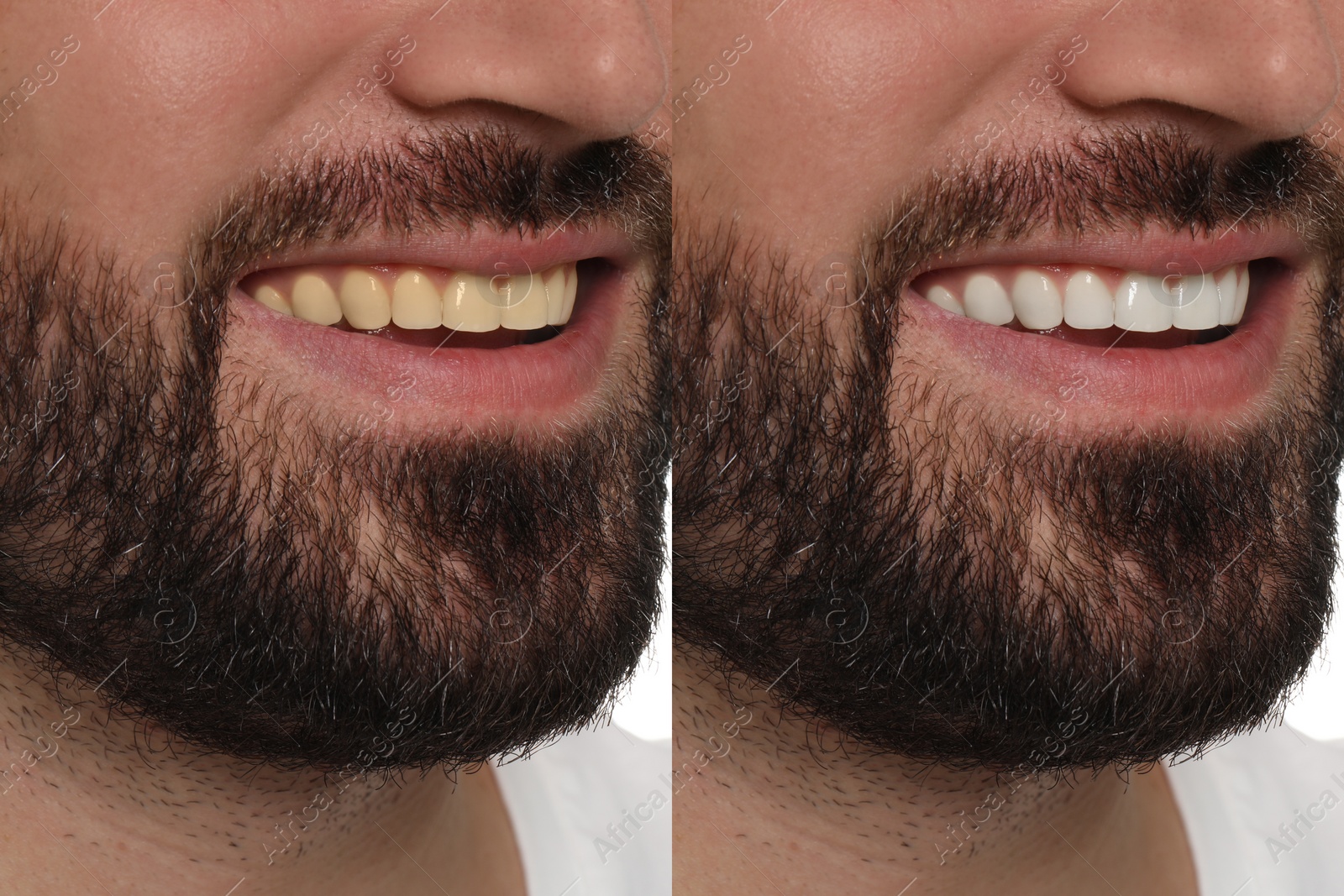 Image of Collage with photos of man before and after tooth whitening, closeup