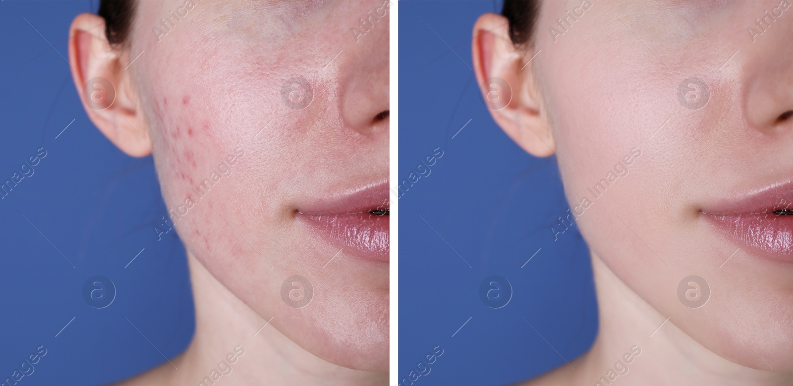 Image of Acne problem. Young woman before and after treatment on blue background, closeup. Collage of photos