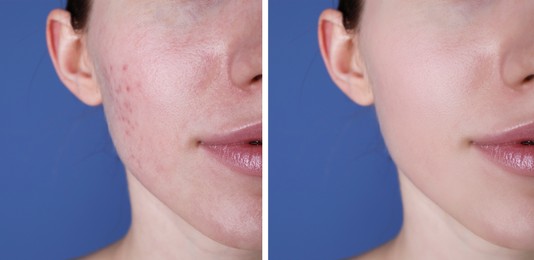 Acne problem. Young woman before and after treatment on blue background, closeup. Collage of photos