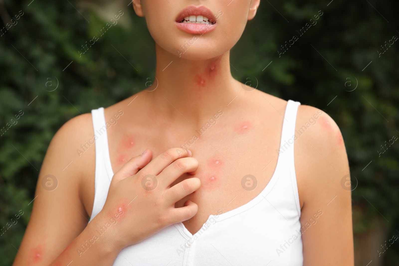 Photo of Woman scratching insect bites in park, closeup