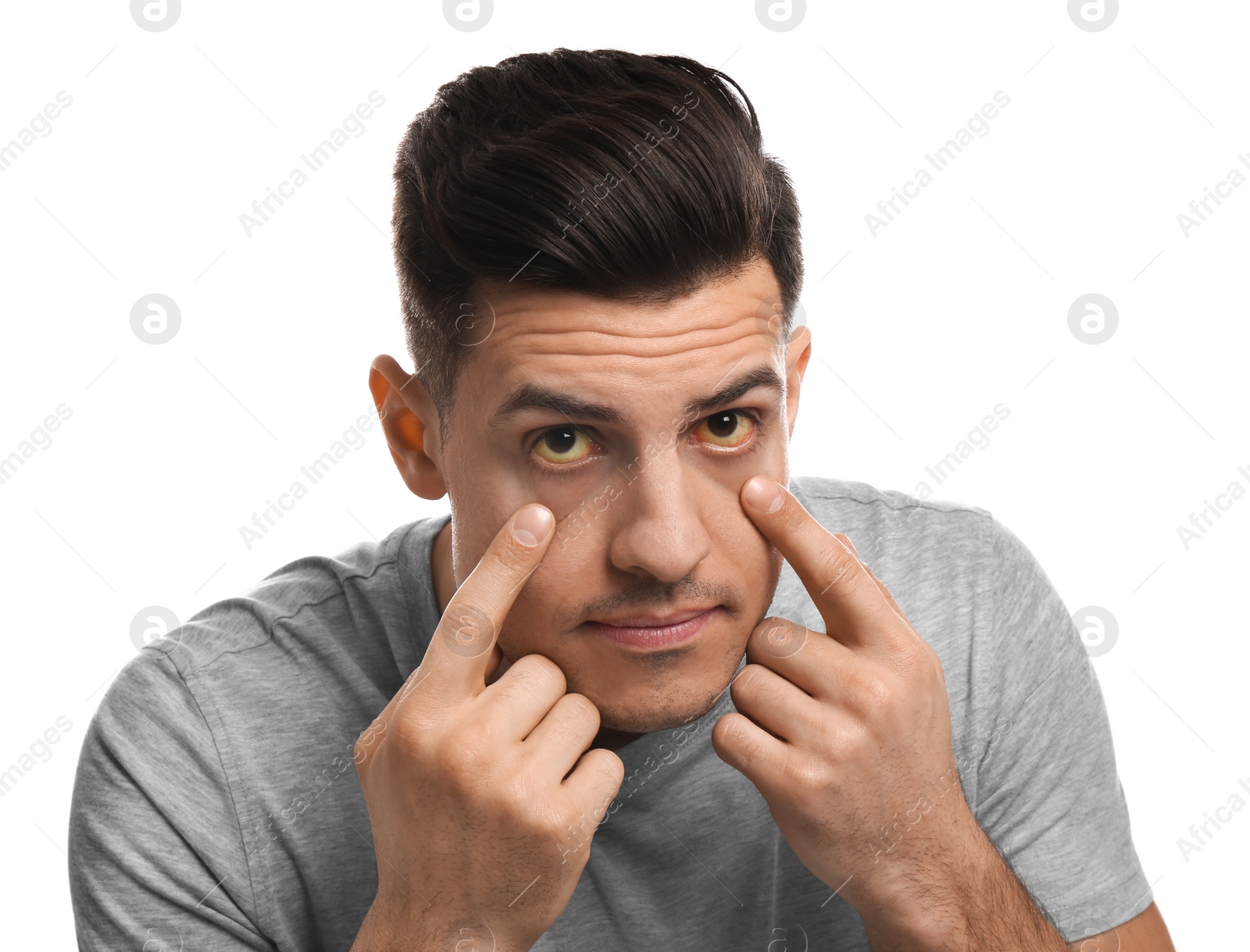 Photo of Man checking his health condition on white background. Yellow eyes as symptom of problems with liver