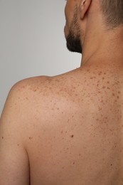 Closeup of man`s body with birthmarks on light grey background, back view