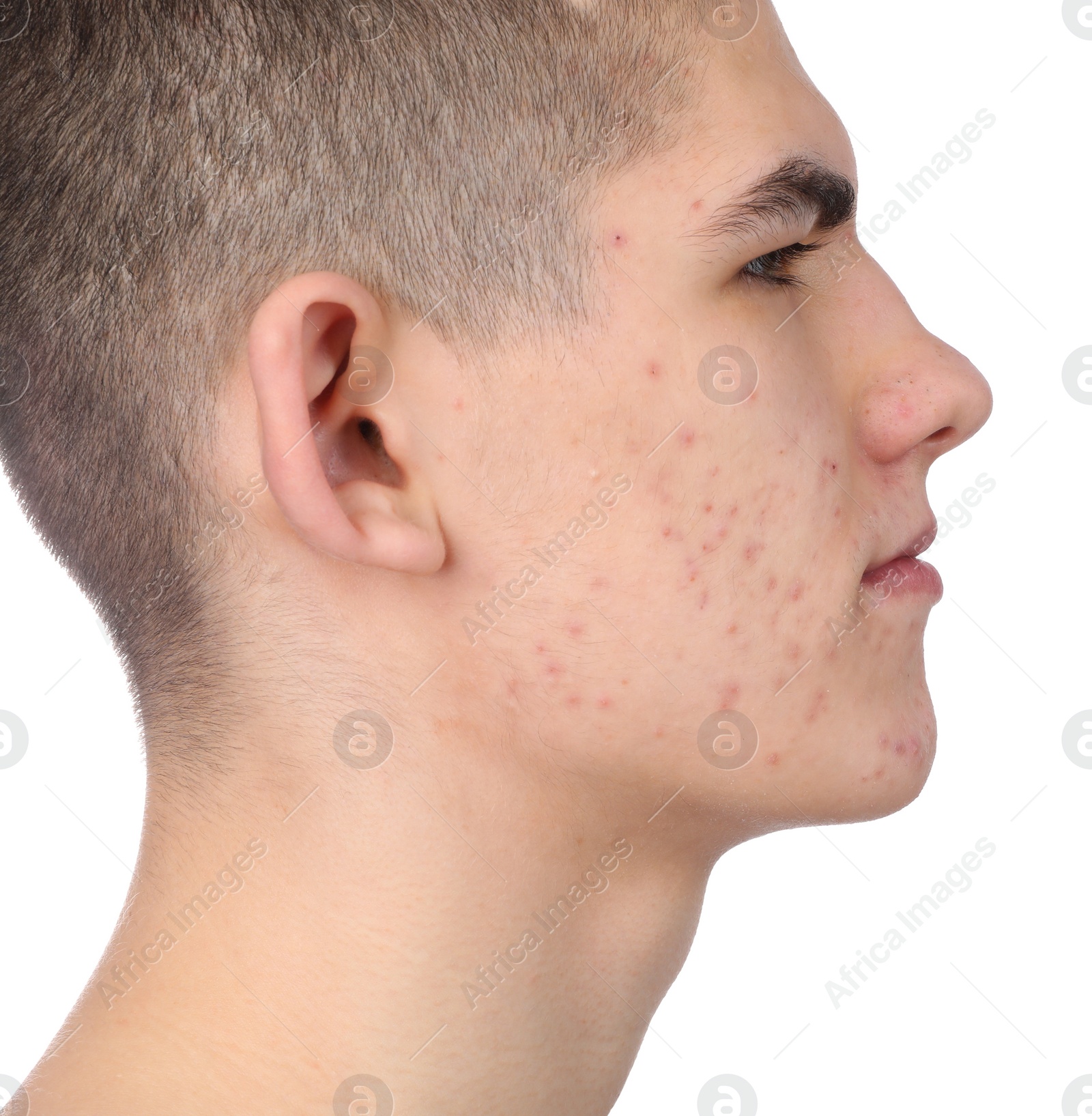 Photo of Young man with acne problem isolated on white