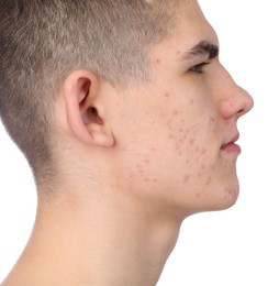 Young man with acne problem isolated on white