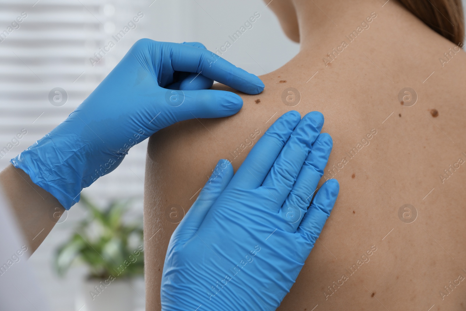 Photo of Dermatologist examining patient's birthmark in clinic, closeup view