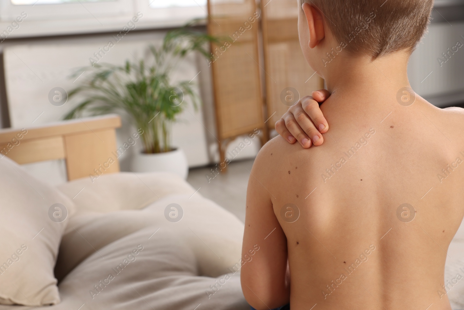 Photo of Closeup of boy's body with birthmarks in living room, back view. Space for text