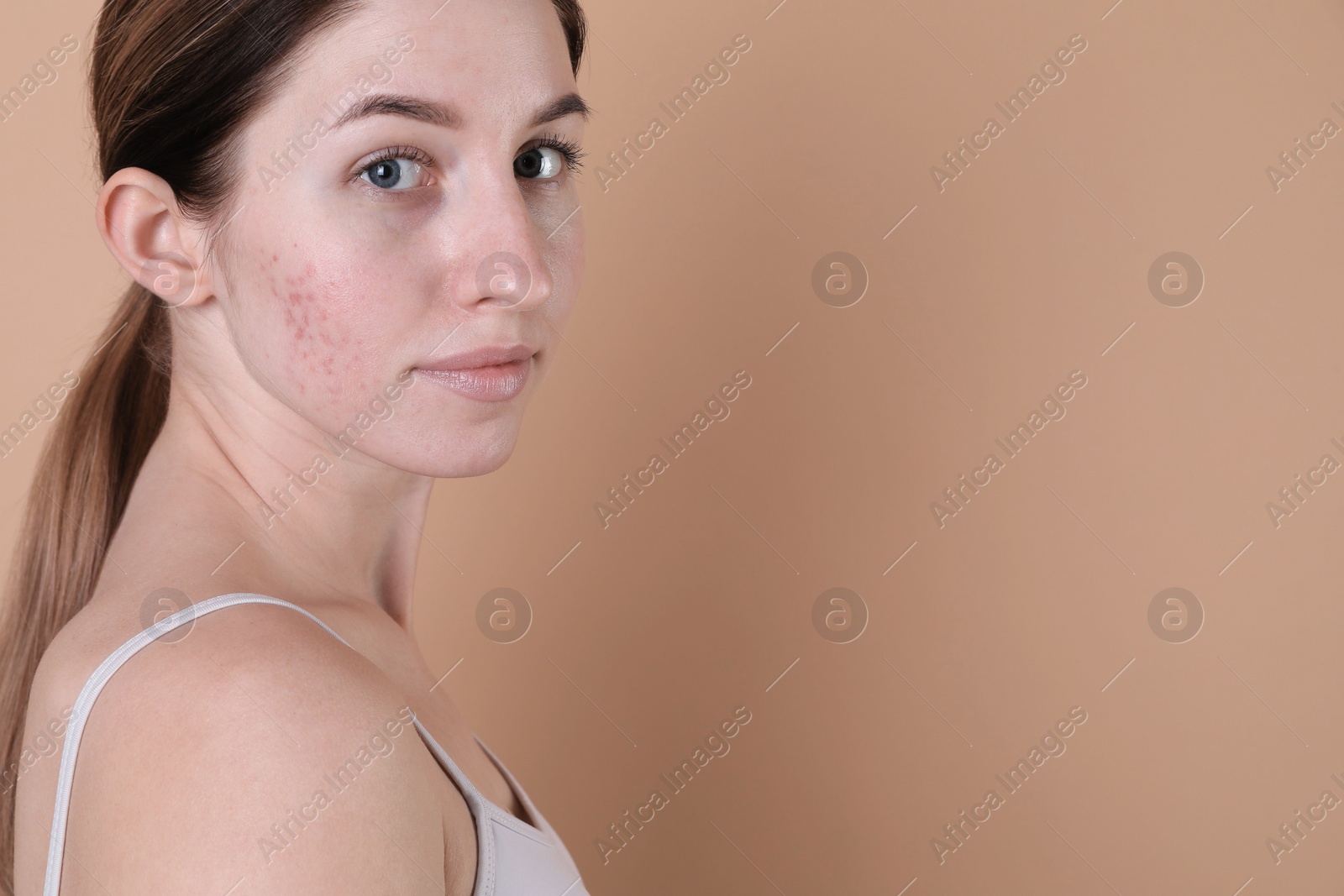 Photo of Young woman with acne problem on beige background. Space for text