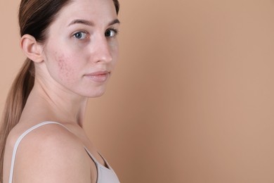 Young woman with acne problem on beige background. Space for text