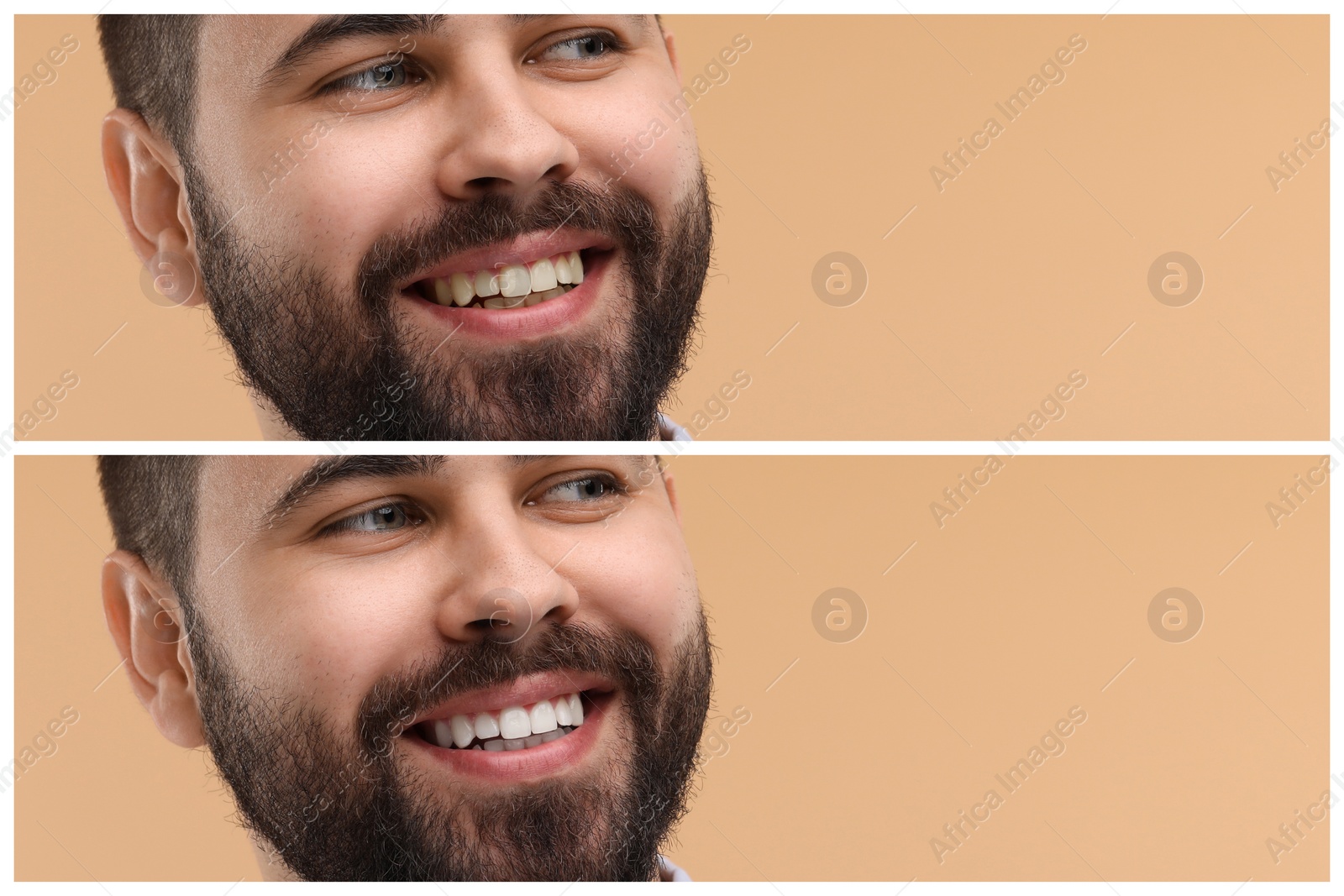 Image of Man showing teeth before and after whitening on beige background, collage