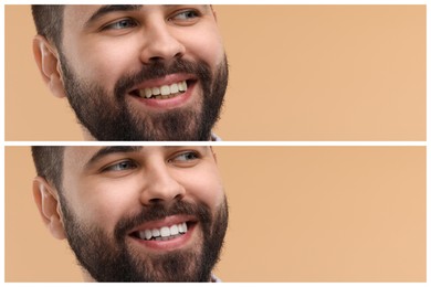 Man showing teeth before and after whitening on beige background, collage