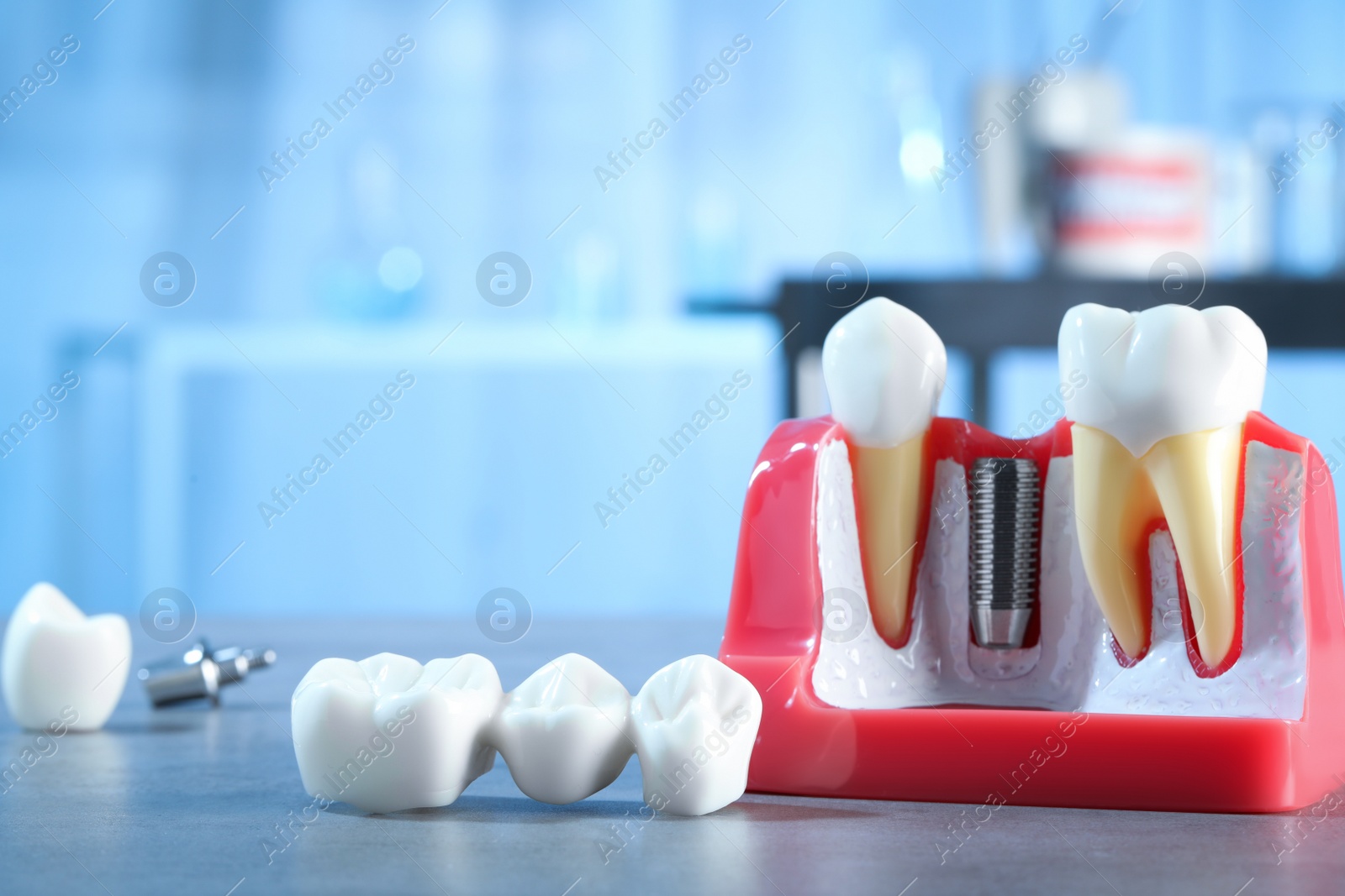 Photo of Educational model with post of dental implant between teeth and crowns on table indoors