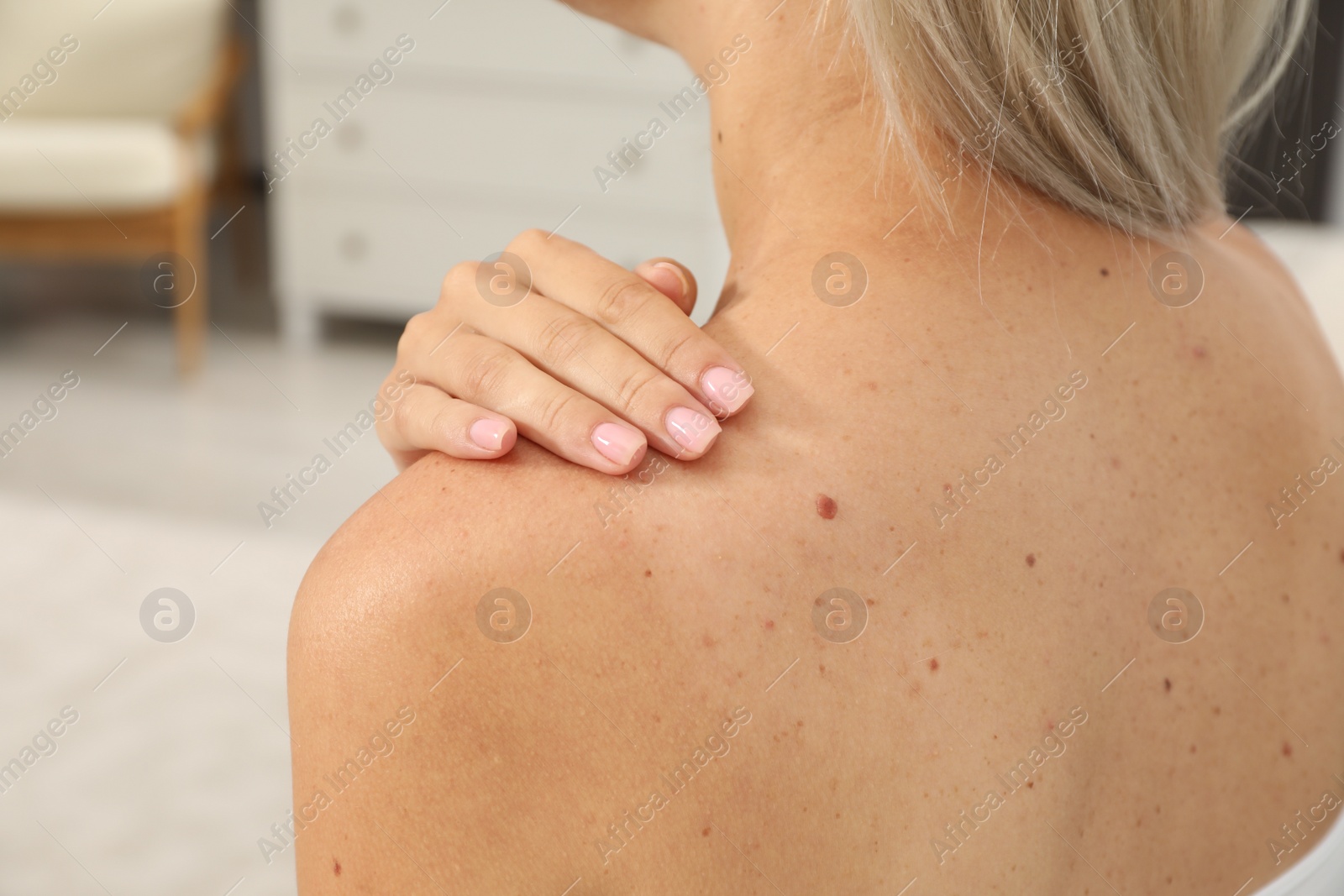 Photo of Closeup view of woman`s body with birthmarks indoors