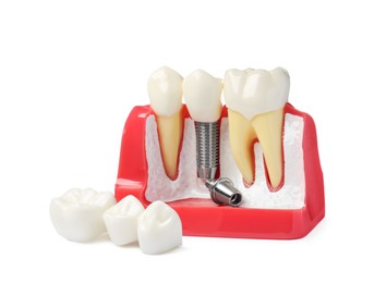 Educational model with dental implant between teeth and crowns on white background