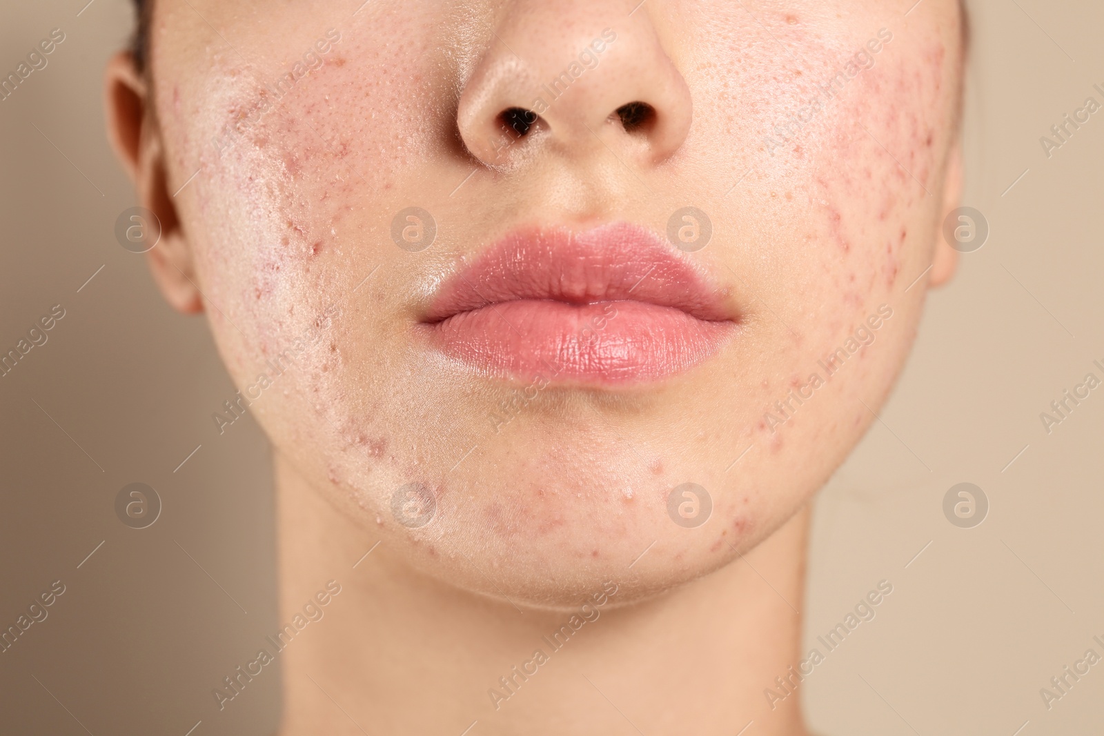 Photo of Teenage girl with acne problem on beige background, closeup