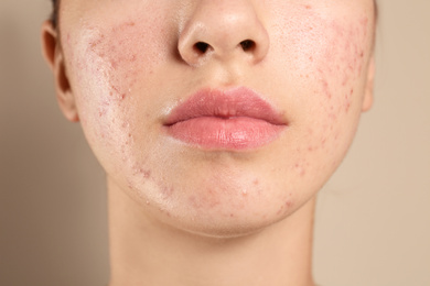 Photo of Teenage girl with acne problem on beige background, closeup