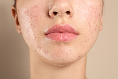 Teenage girl with acne problem on beige background, closeup