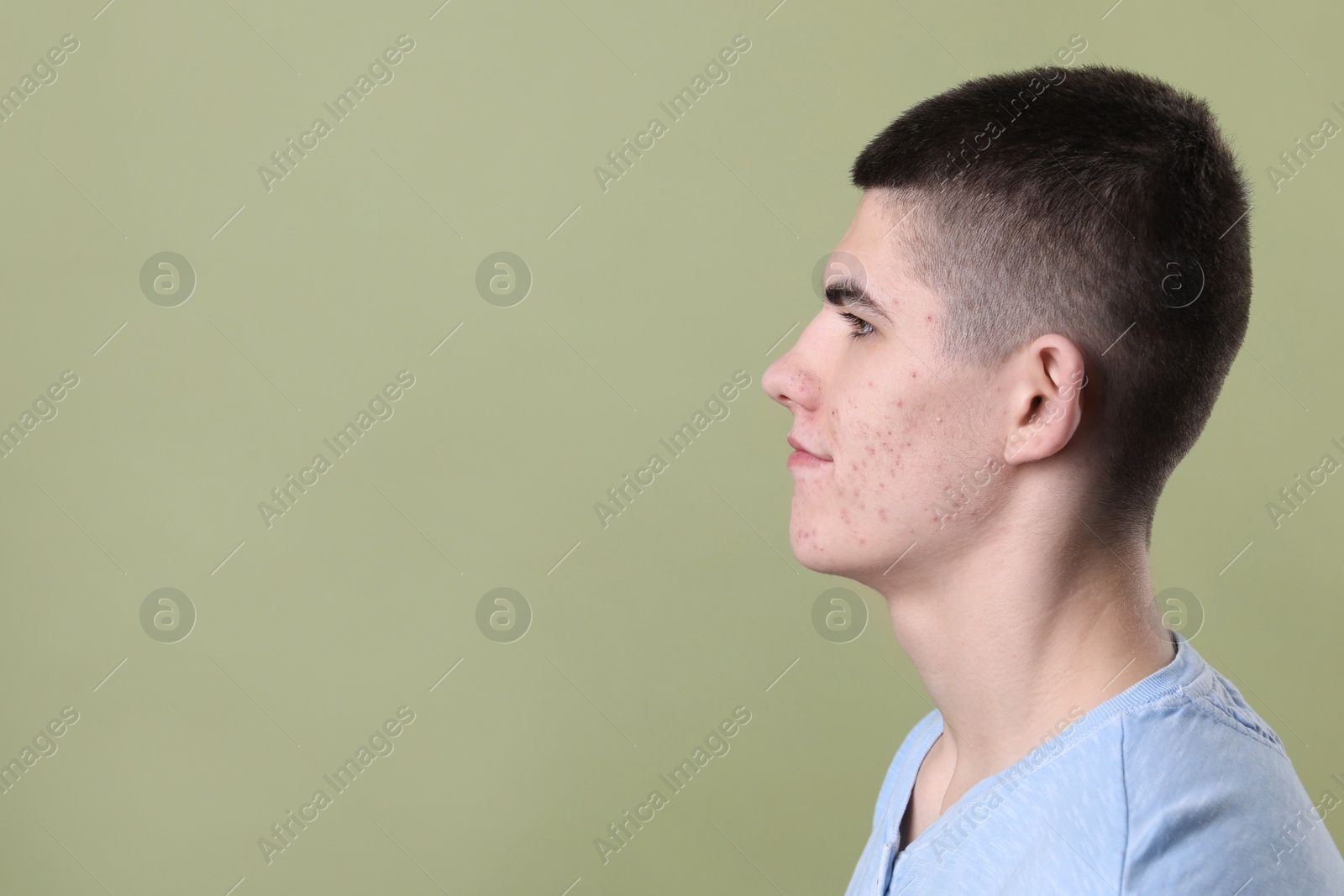 Photo of Young man with acne problem on olive background. Space for text