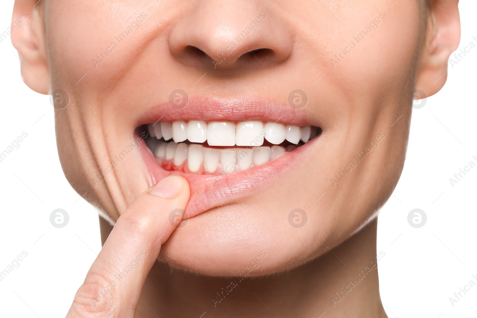 Image of Woman showing inflamed gum on white background, closeup