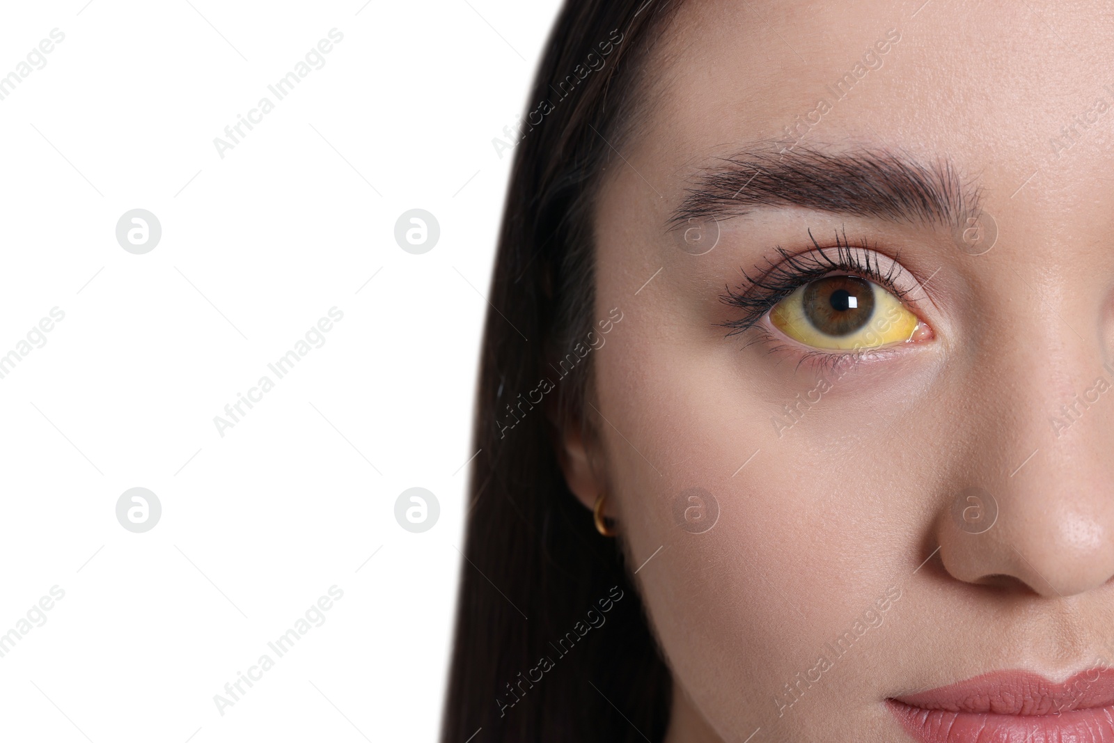 Photo of Woman with yellow eyes on white background, closeup. Symptom of hepatitis