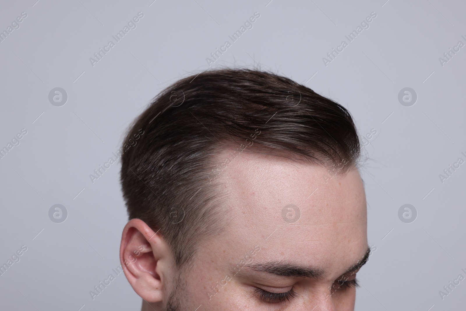 Photo of Baldness concept. Man with receding hairline on light grey background, closeup