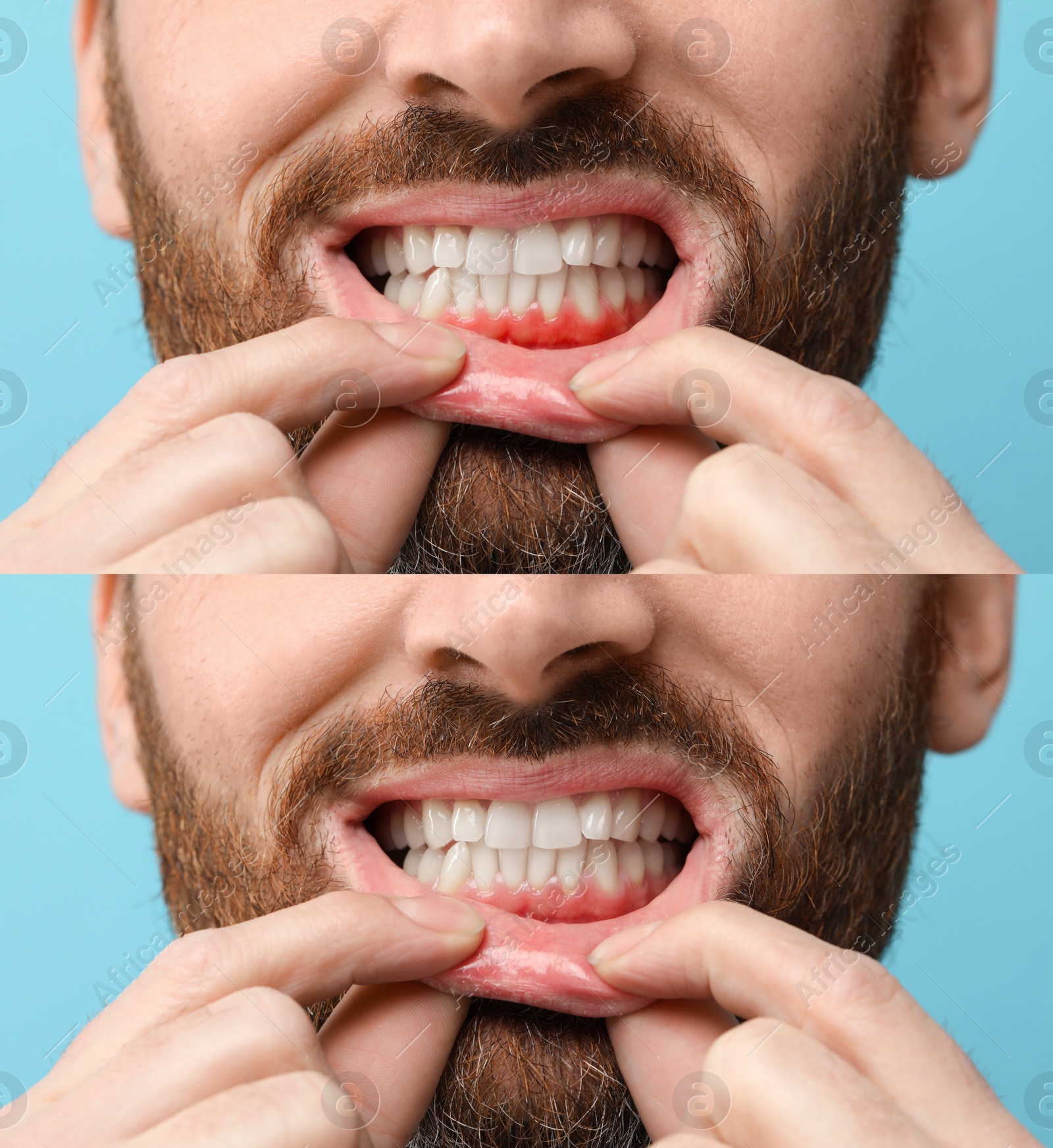 Image of Man showing gum before and after treatment on light blue background, collage of photos