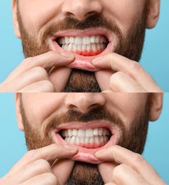 Man showing gum before and after treatment on light blue background, collage of photos